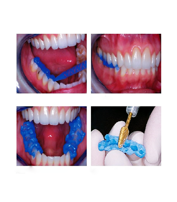 ماده بیس اکریل ثبت روابط فکی DMG _ Luxabite